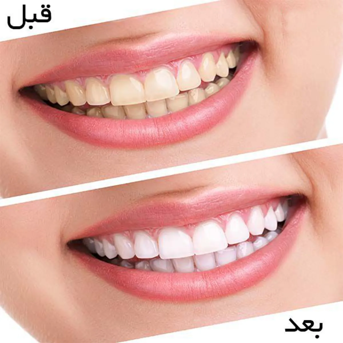 سفید کننده دندان مدل light white